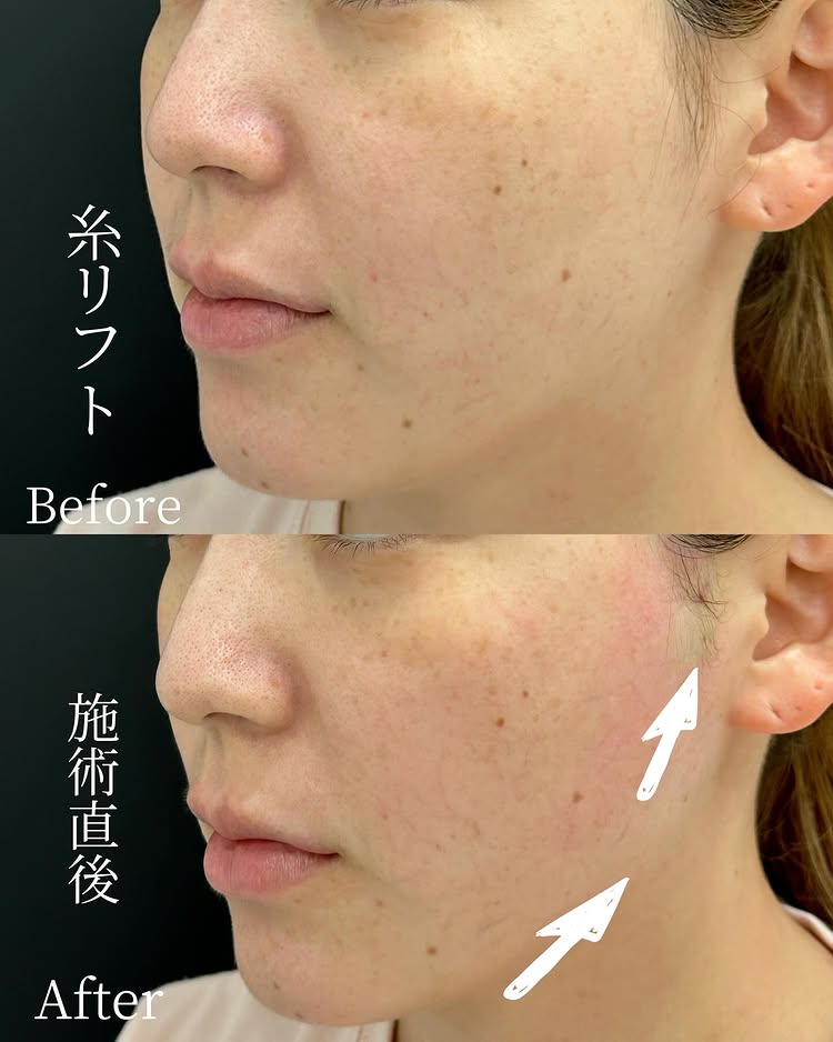 糸リフトの症例写真 (45)