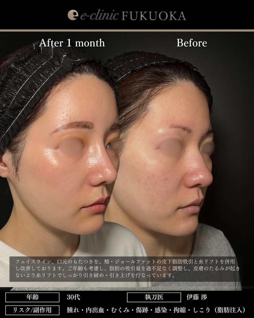 鼻尖形成と軟骨移植と小鼻縮小とプロテーゼと額の脂肪注入と頬の脂肪吸引とジョールファットと糸リフトの症例写真 (3)