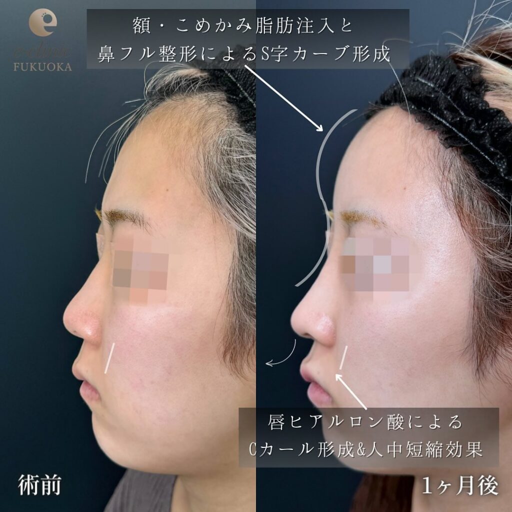 鼻尖形成と軟骨移植とプロテーゼと額とこめかみの脂肪注入と唇のヒアルロン酸の症例写真 (2)