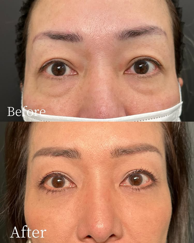 裏ハムラ法の症例写真 (80)