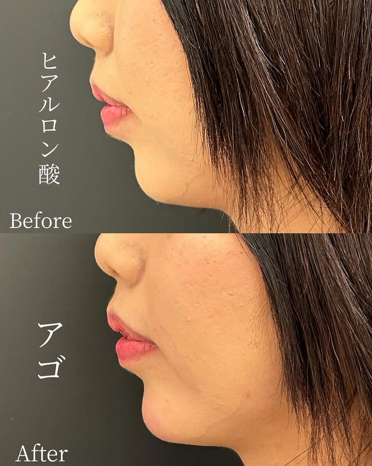 顎のヒアルロン酸の症例写真 (17)