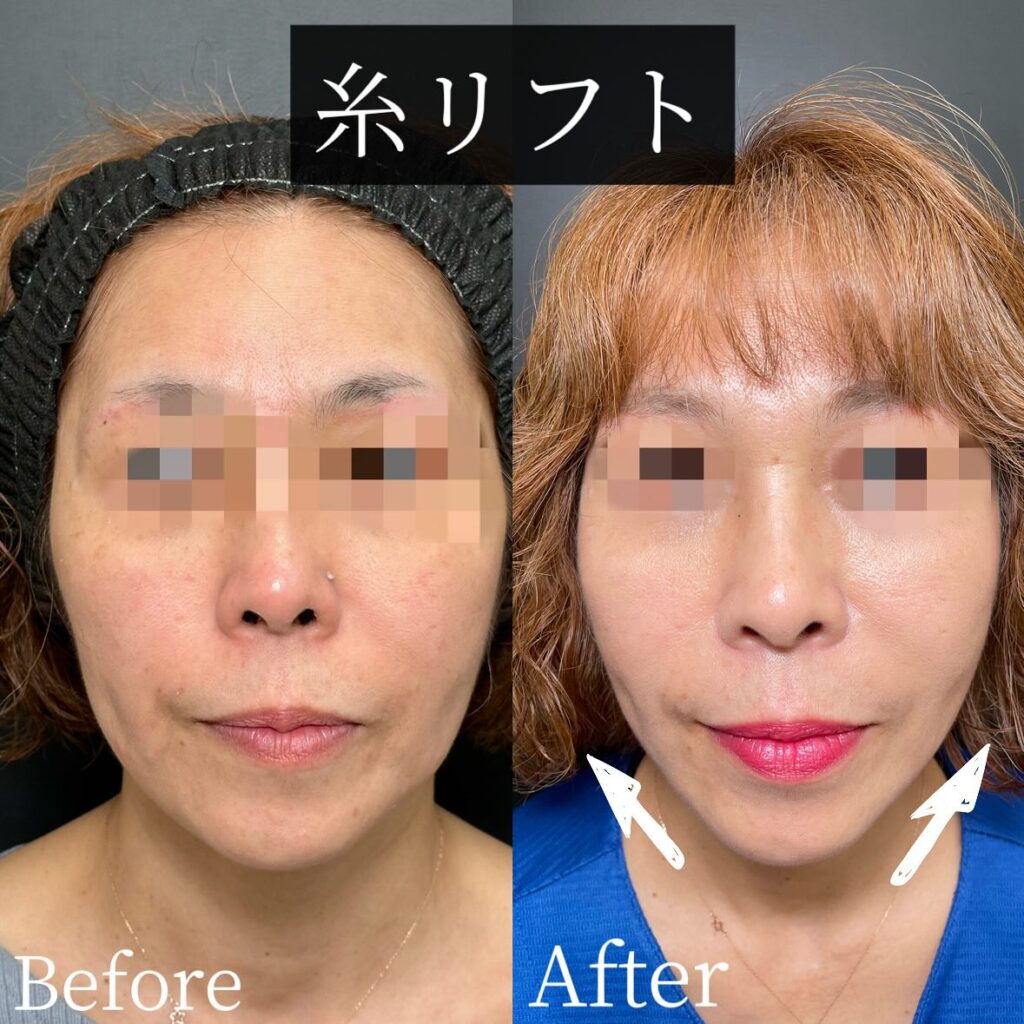 糸リフトの症例写真 (22)