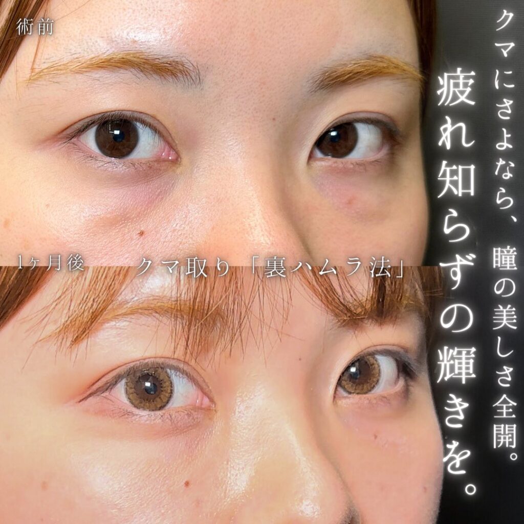 裏ハムラ法の症例写真 (36)