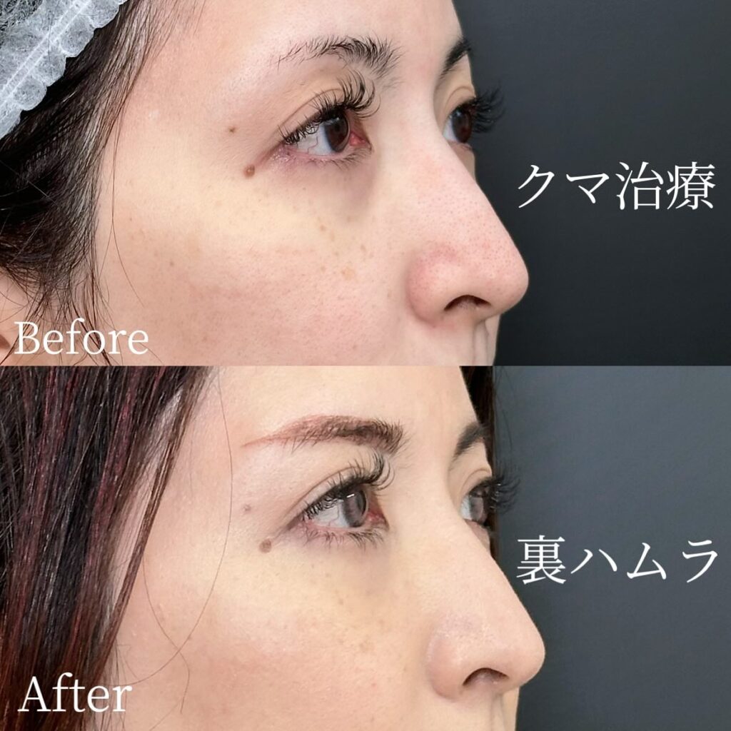 裏ハムラ法の症例写真 (36)