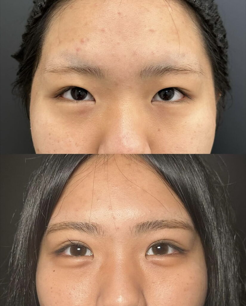 埋没法の症例写真 (1)