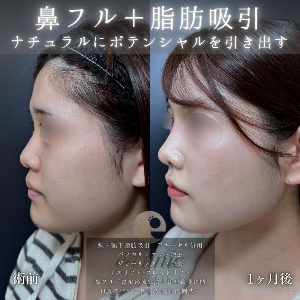 頬と顎下の脂肪吸引とバッカルファットとジョールファットと糸リフトと鼻尖形成と軟骨移植とプロテーゼと小鼻縮小の症例写真 (2)