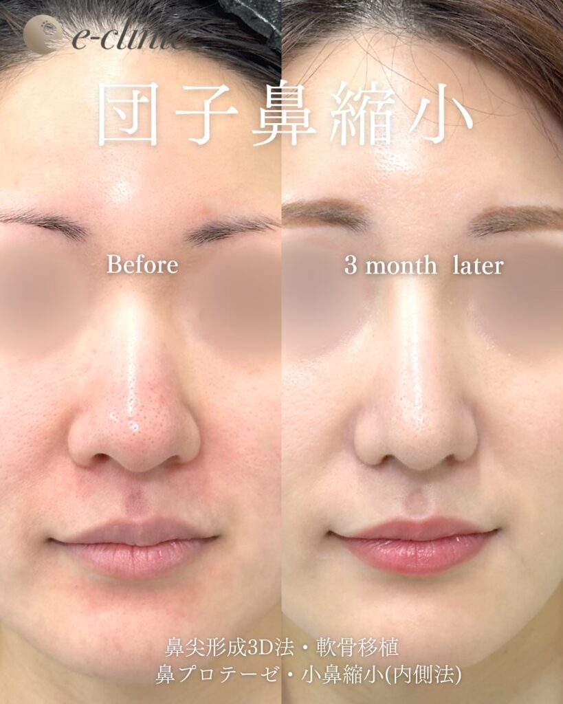 鼻尖形成と軟骨移植とプロテーゼと小鼻縮小と脂肪注入と頬の脂肪吸引とジョールファットと糸リフトの症例写真 (1)