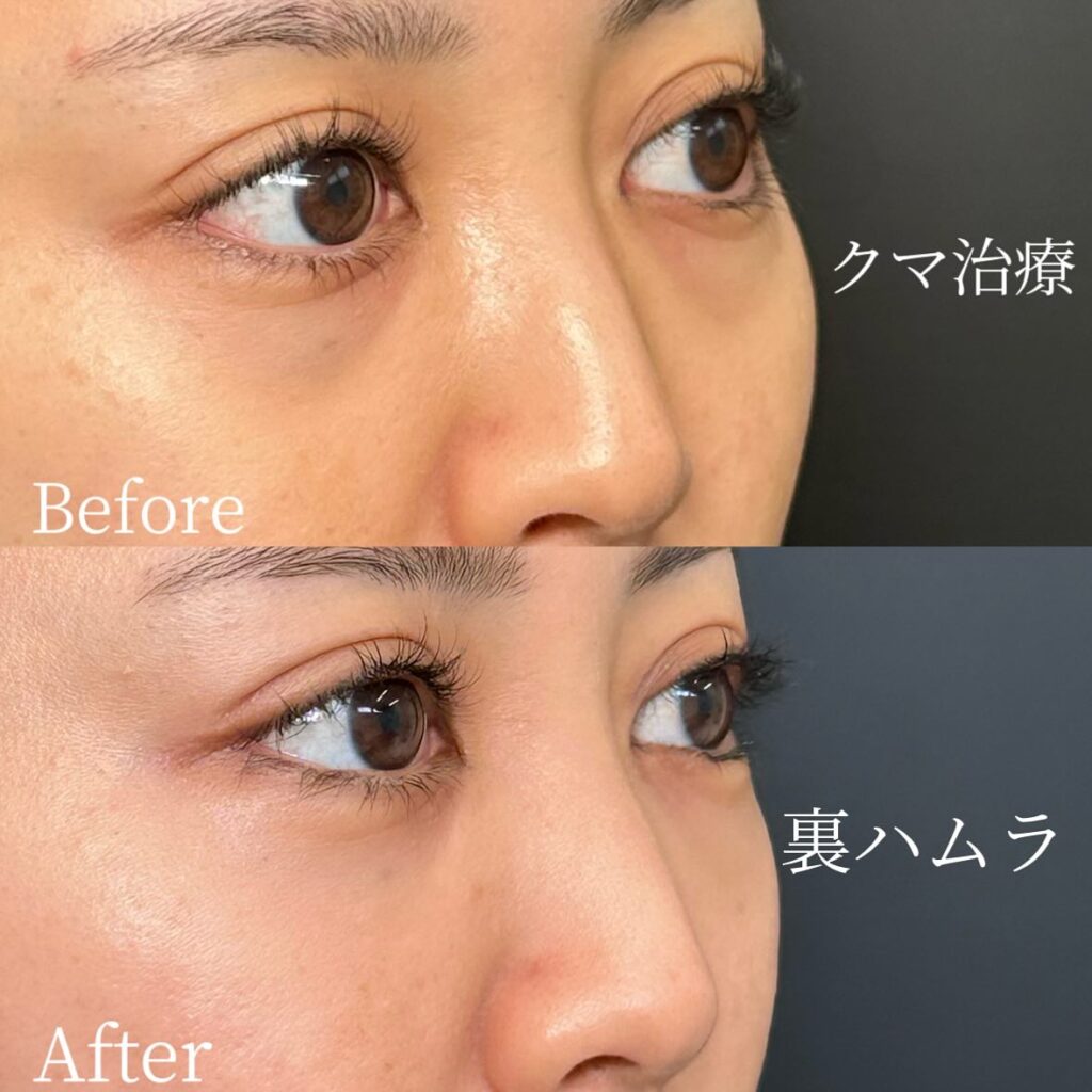 裏ハムラ法の症例写真 (41)