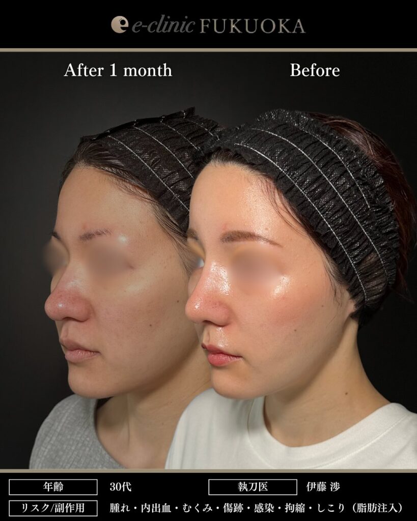 鼻尖形成と軟骨移植と小鼻縮小とプロテーゼと額とこめかみの脂肪注入と頬の脂肪吸引とジョールファットと糸リフトの症例写真 (2)