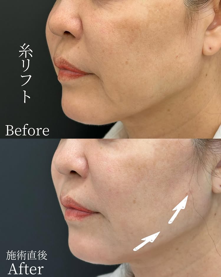 糸リフトの症例写真 (46)