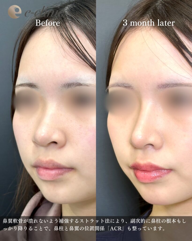 鼻尖形成と軟骨移植とプロテーゼと小鼻縮小の症例写真 (26)