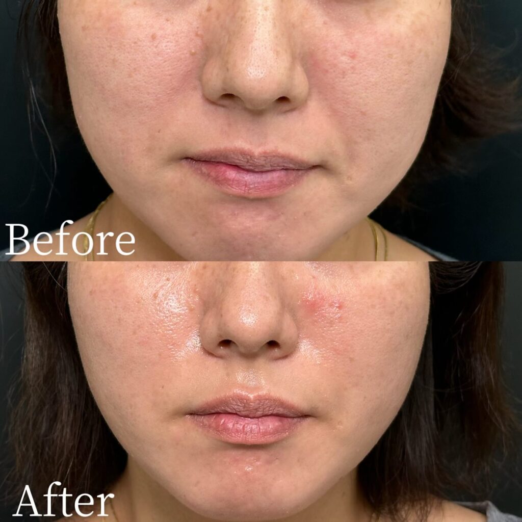 法令線のヒアルロン酸の症例写真 (16)