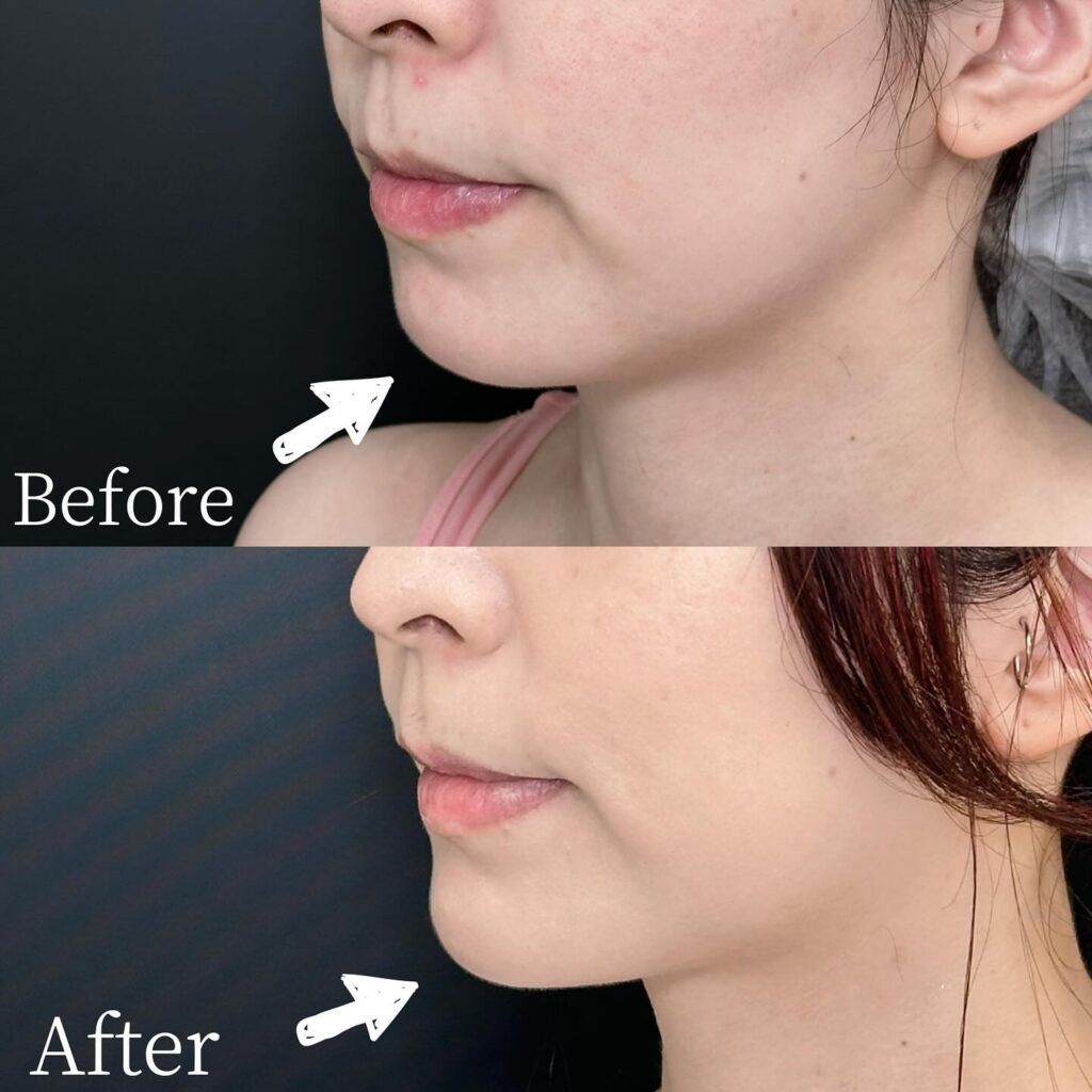 顎のヒアルロン酸の症例写真 (14)