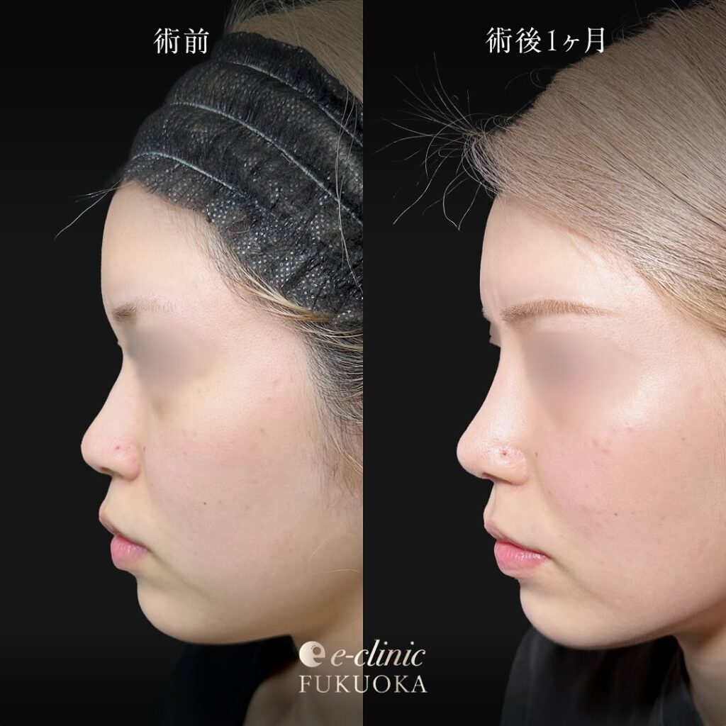 鼻尖形成と軟骨移植とプロテーゼと小鼻縮小の症例写真 (8)