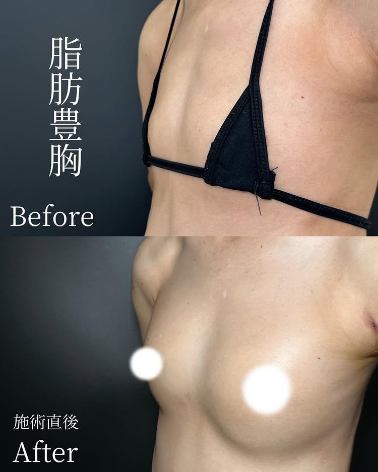 脂肪豊胸の症例写真