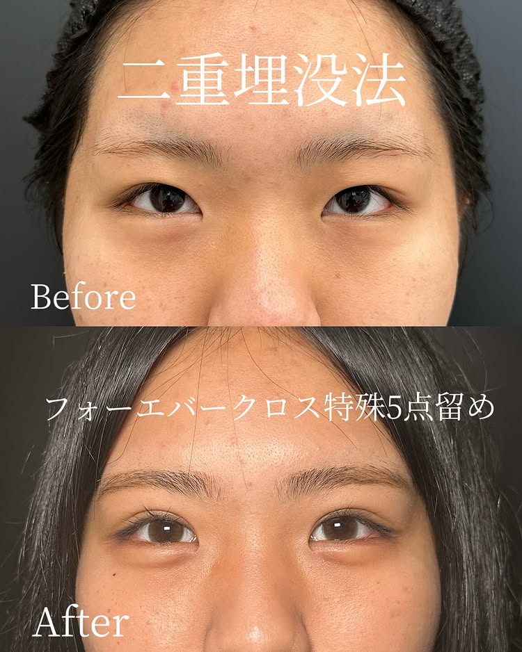 埋没法の症例写真 (11)