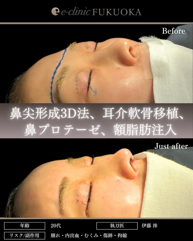 鼻尖形成と軟骨移植とプロテーゼと額とこめかみの脂肪注入の症例写真