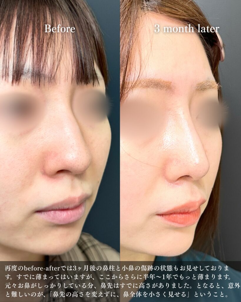 鼻尖形成と軟骨移植とプロテーゼと小鼻縮小の症例写真 (20)