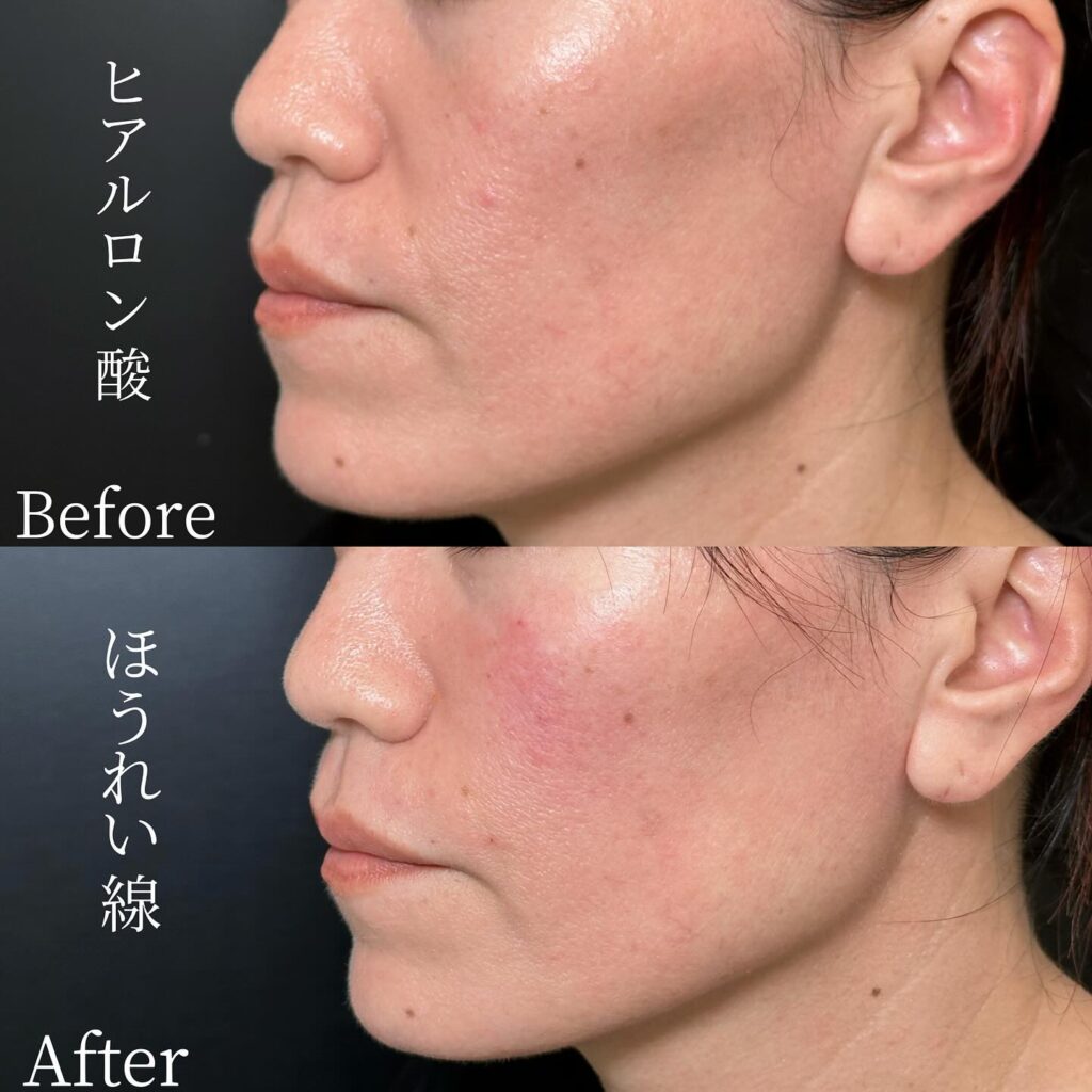法令線のヒアルロン酸 (1)
