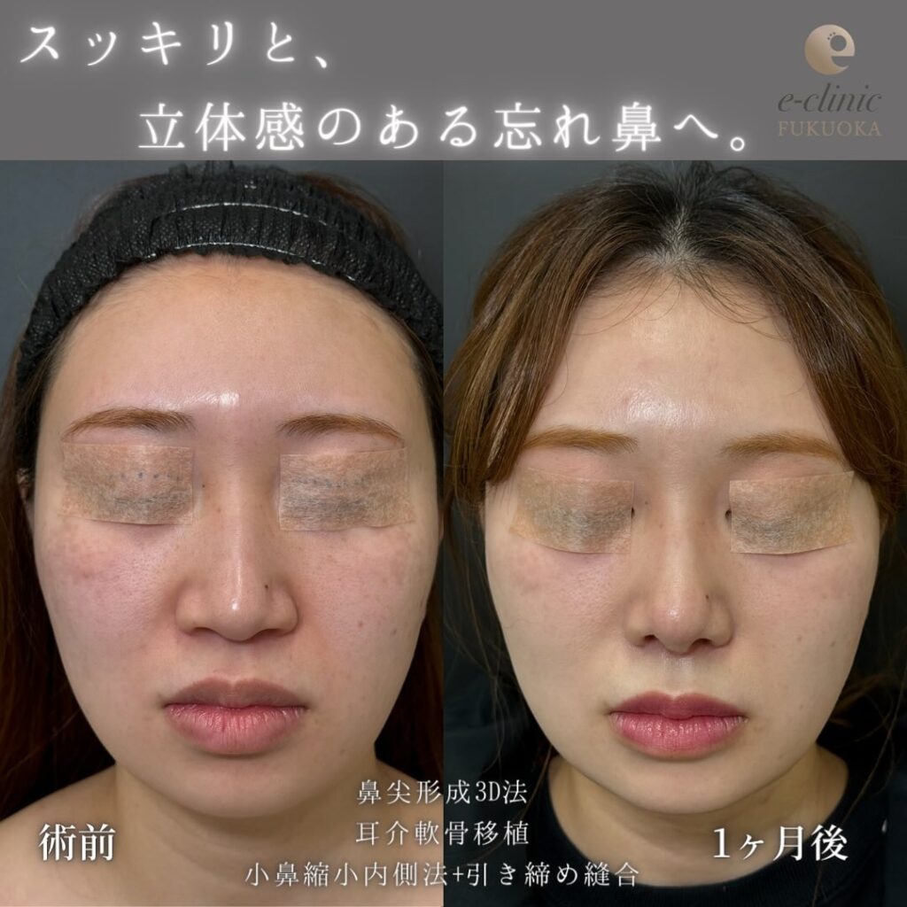 鼻尖形成と軟骨移植と小鼻縮小の症例写真 (11)