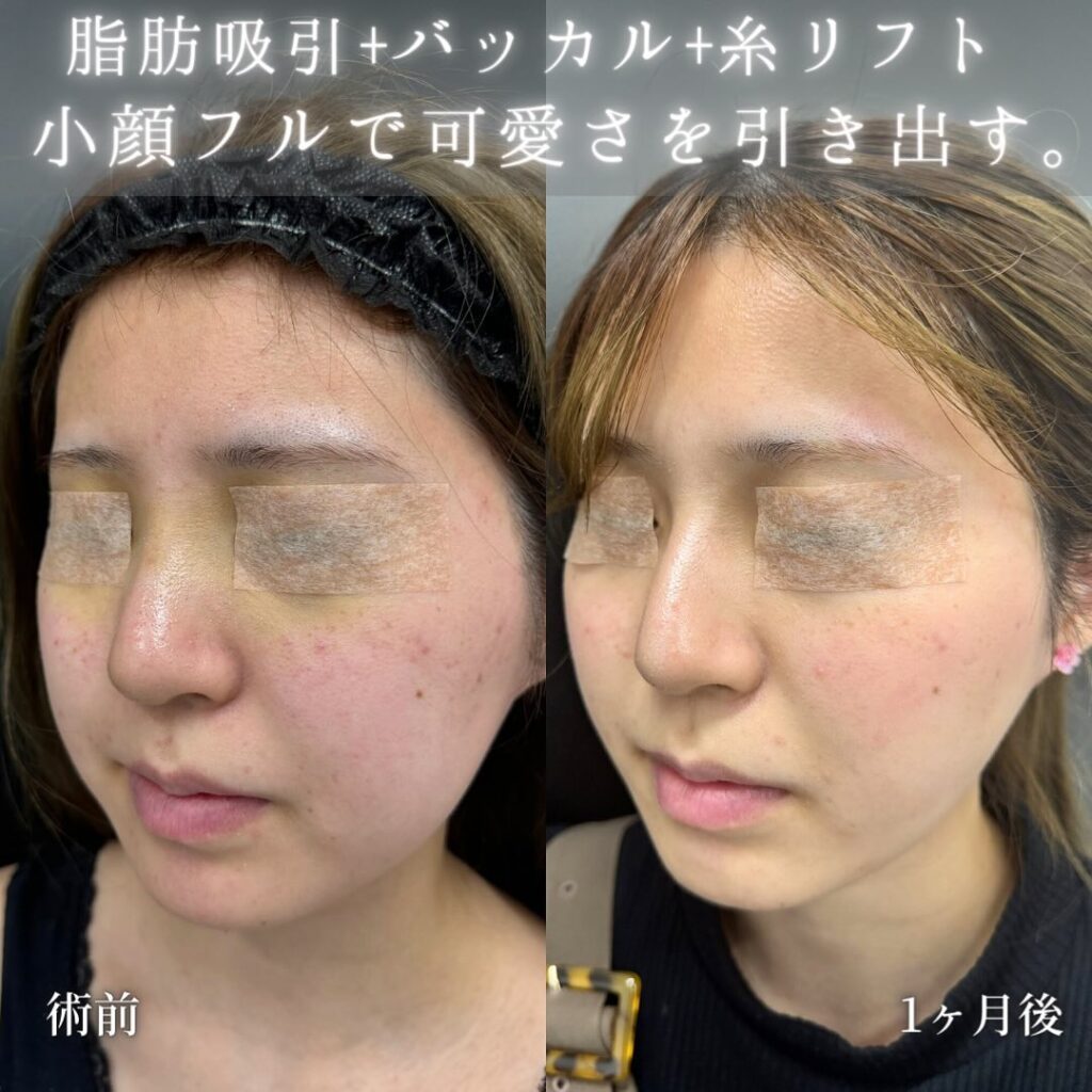 小顔脂肪吸引とバッカルファットとジョールファットとメーラーファットと糸リフトの症例写真 (3)