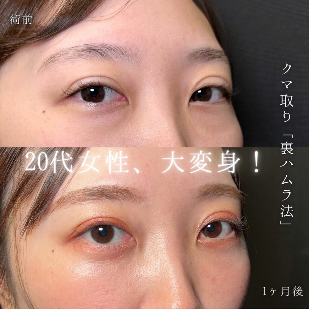 裏ハムラ法の症例写真 (40)