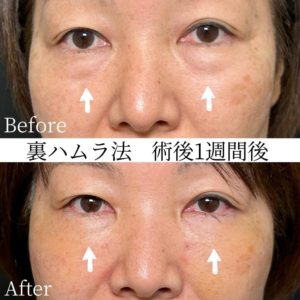 裏ハムラ法の症例写真 (40)