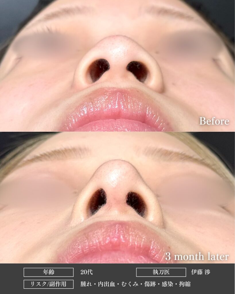 鼻尖形成と軟骨移植とプロテーゼと小鼻縮小の症例写真 (11)