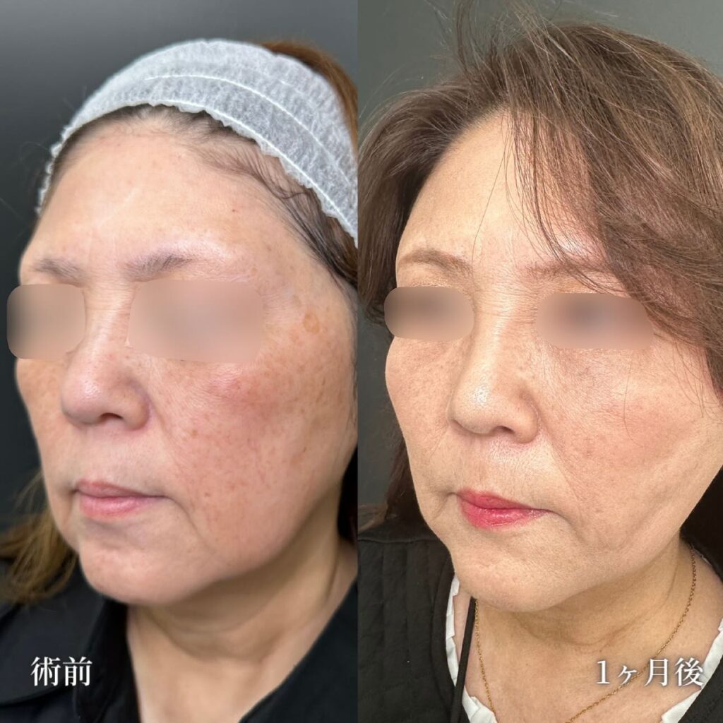 ハイブリッドフェイスリフトの症例写真 (3)