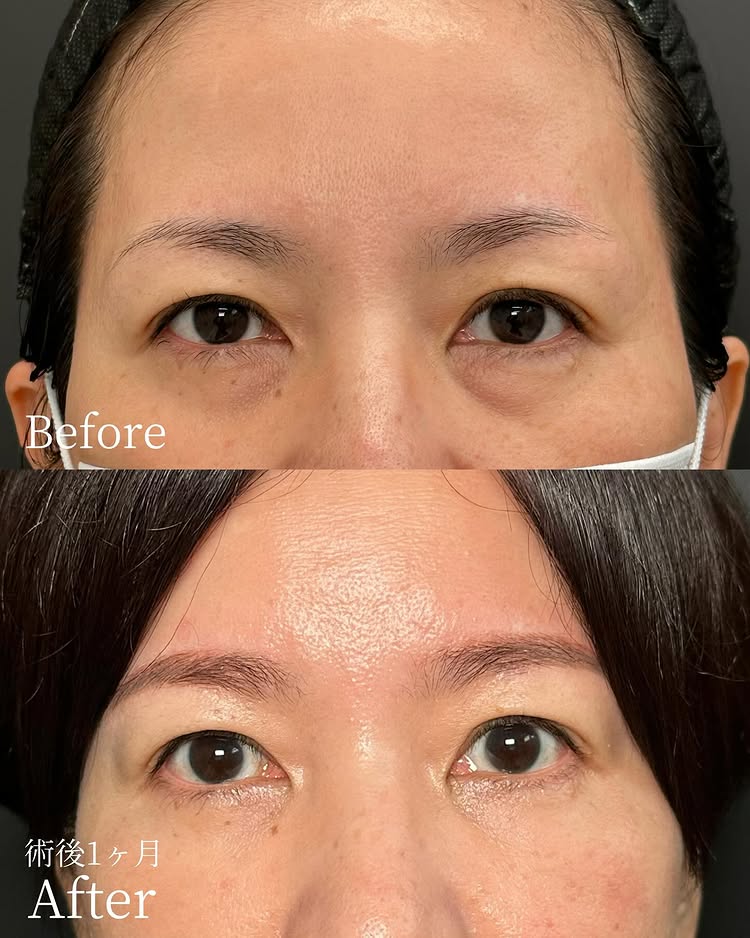 裏ハムラ法の症例写真 (82)