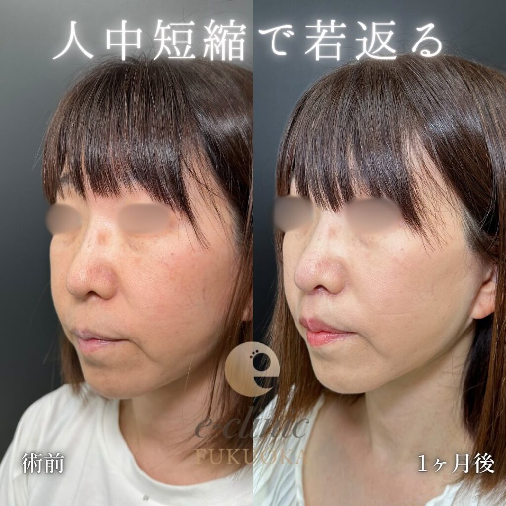 人中短縮の症例写真 (7)