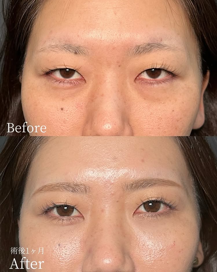 裏ハムラ法の症例写真 (88)