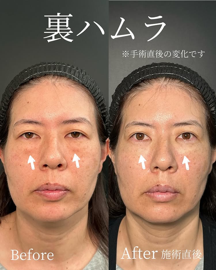 裏ハムラ法の症例写真 (75)