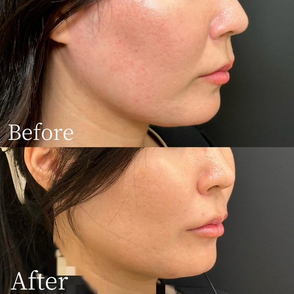 法令線のヒアルロン酸の症例写真 (14)