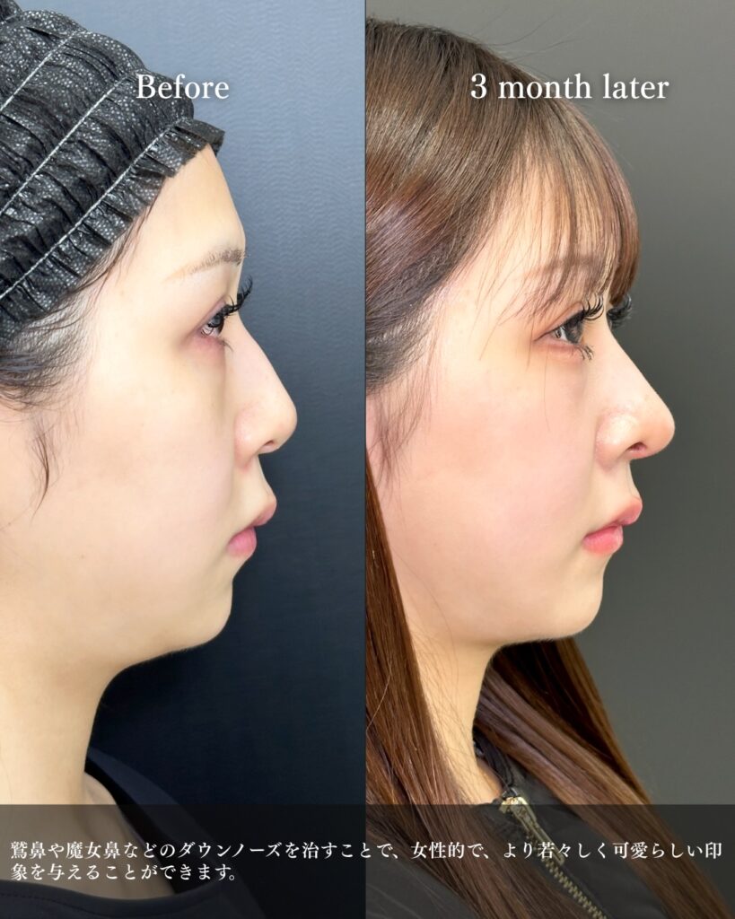 鼻中隔延長と鼻尖形成と軟骨移植と鷲鼻修正の症例写真 (8)