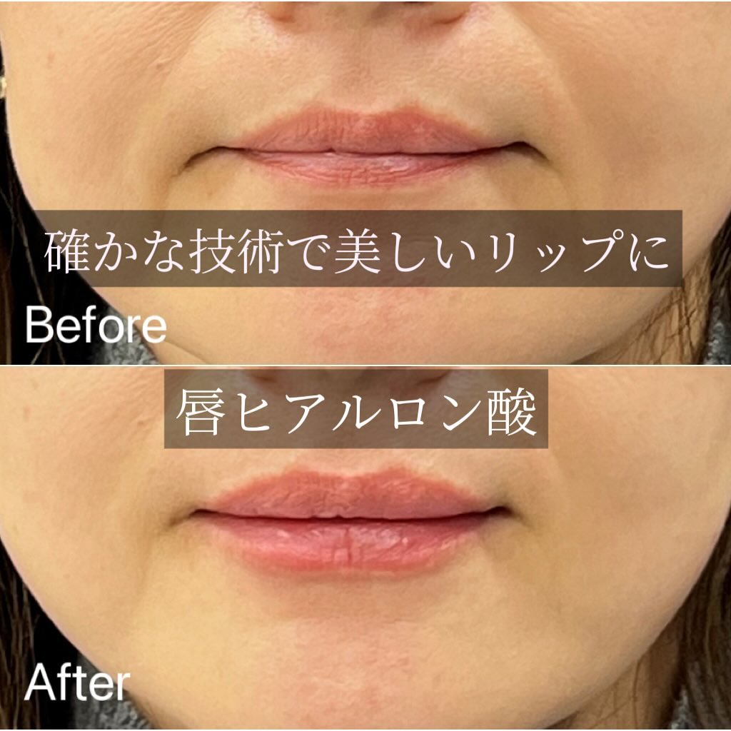 唇のヒアルロン酸の症例写真 (14)