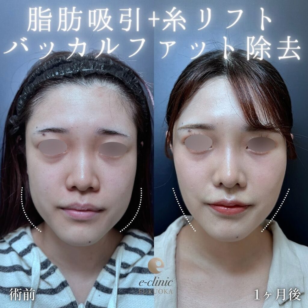 顔の脂肪吸引と糸リフトとバッカルファットの症例写真 (4)