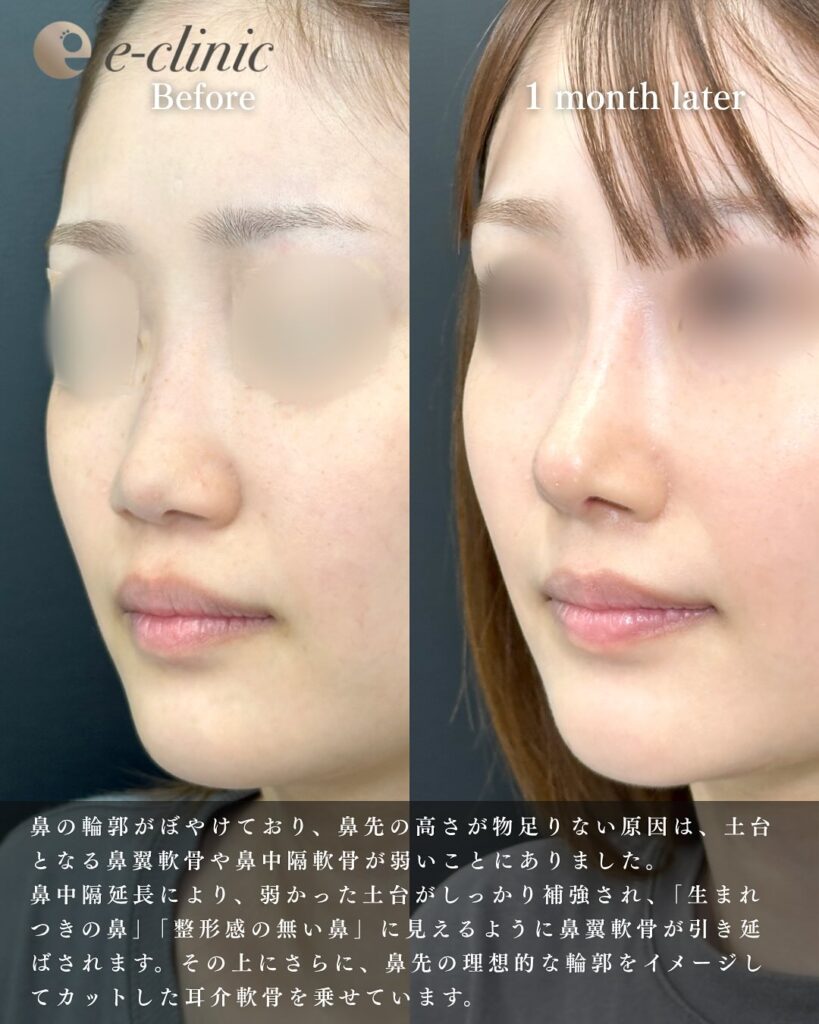 鼻中隔延長と鼻尖形成と軟骨移植とプロテーゼの症例写真 (5)