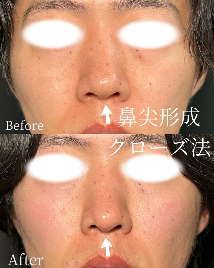 鼻尖形成と軟骨移植症例写真 (1)