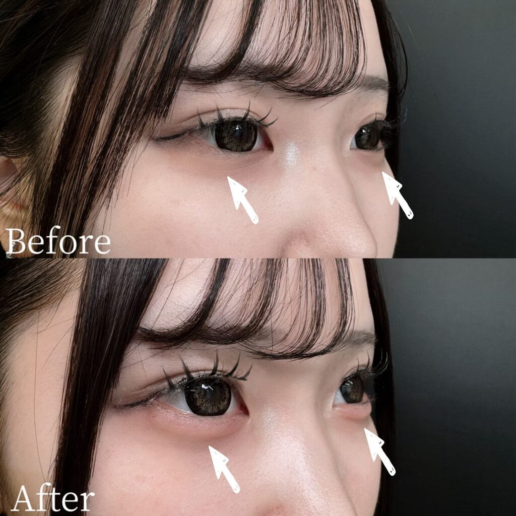 涙袋のヒアルロン酸の症例写真 (8)