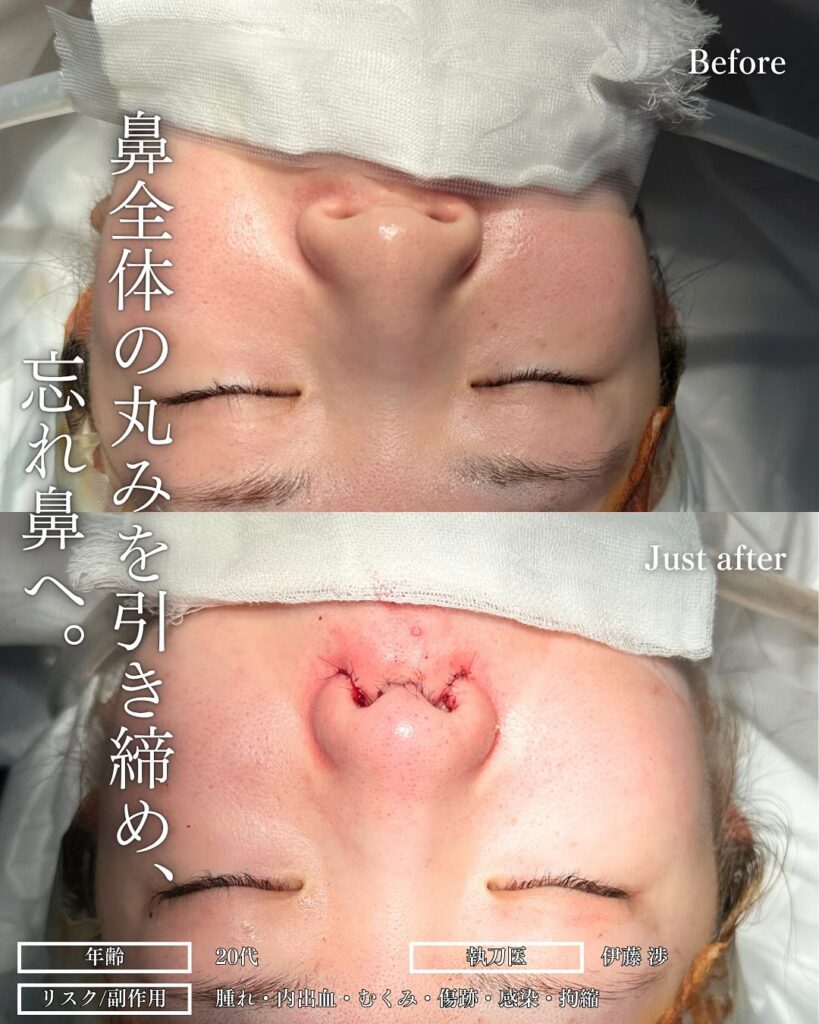 鼻尖形成と耳介軟骨移植と小鼻縮小の症例写真 (4)