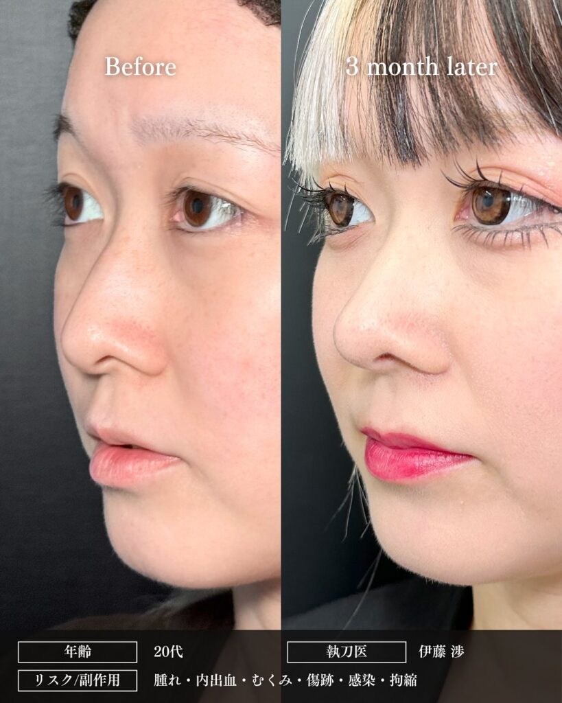 鼻中隔延長と鼻尖形成と軟骨移植と小鼻縮小の症例写真 (6)