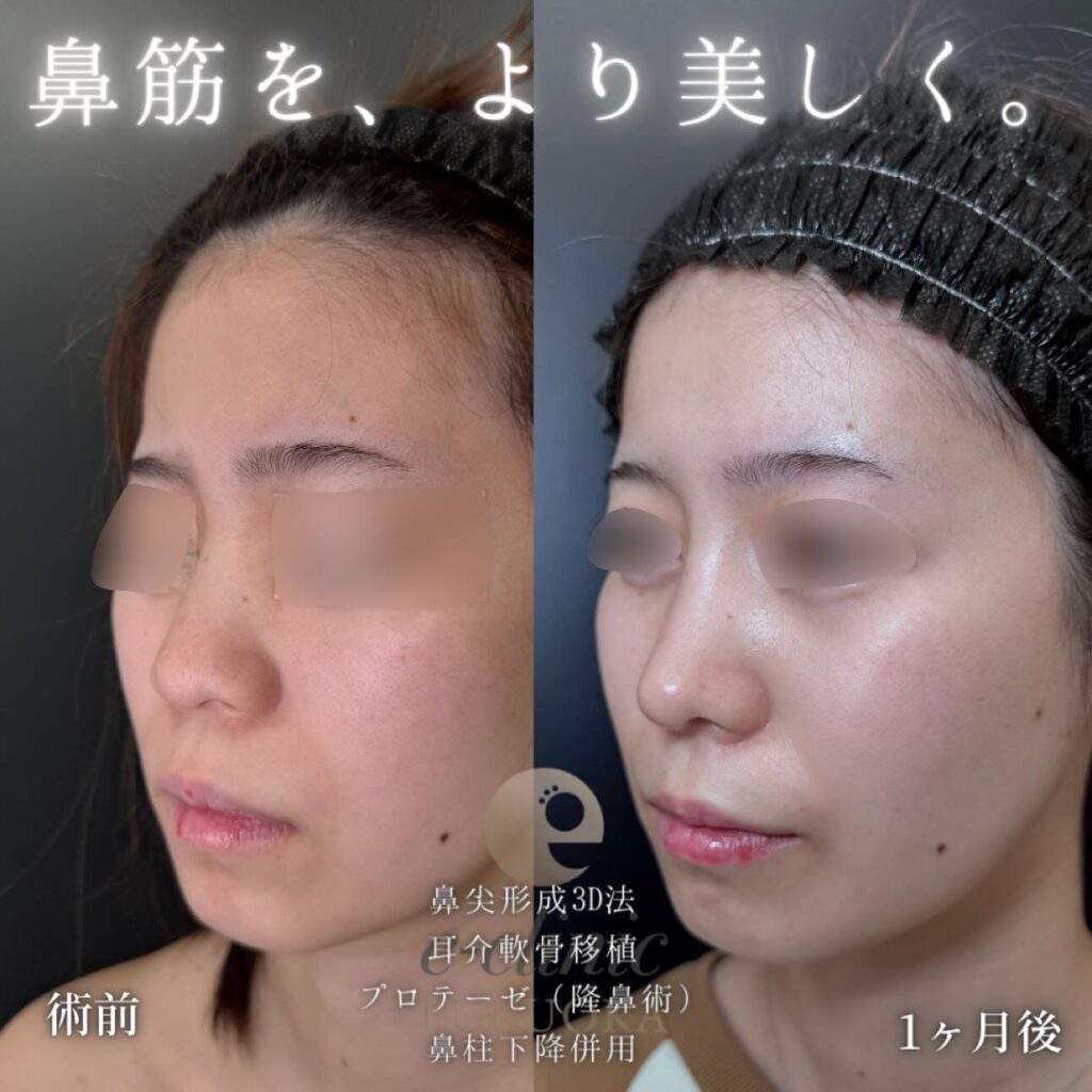 鼻尖形成と耳介軟骨移植とプロテーゼと鼻柱下降の症例写真 (1)