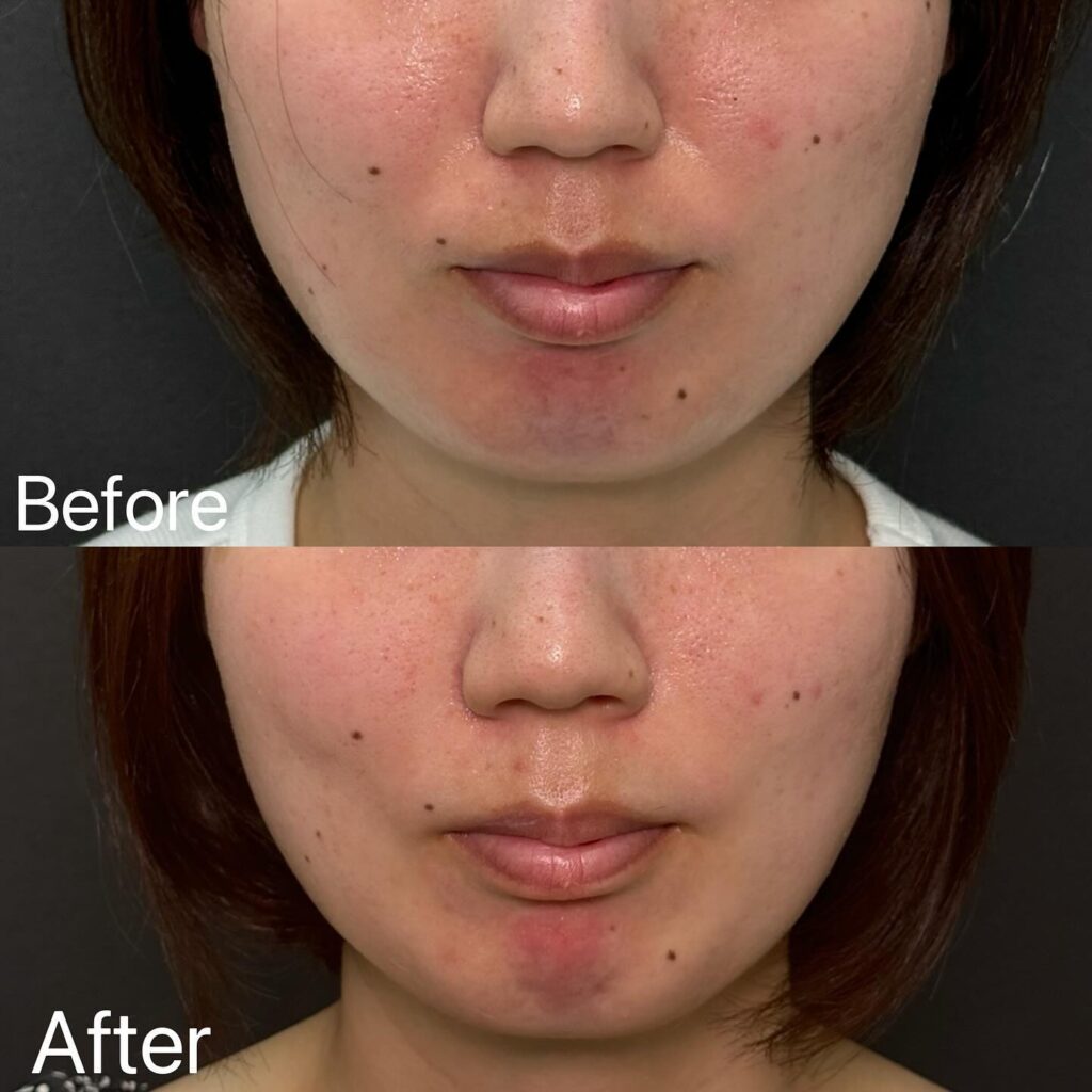 法令線のヒアルロン酸の症例写真 (8)