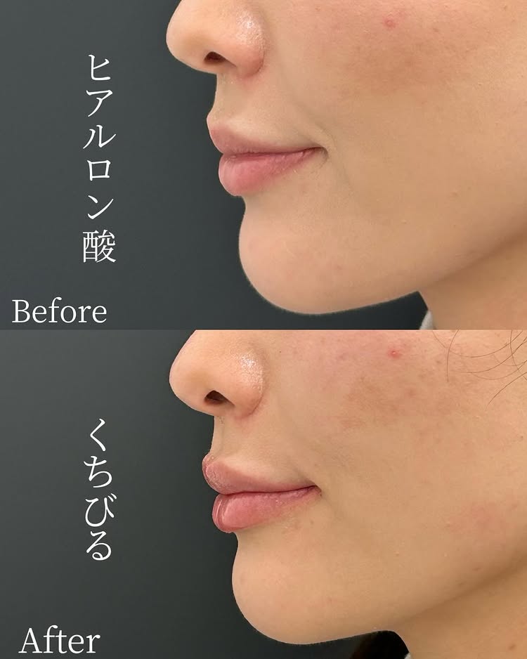 唇のヒアルロン酸の症例写真 (42)