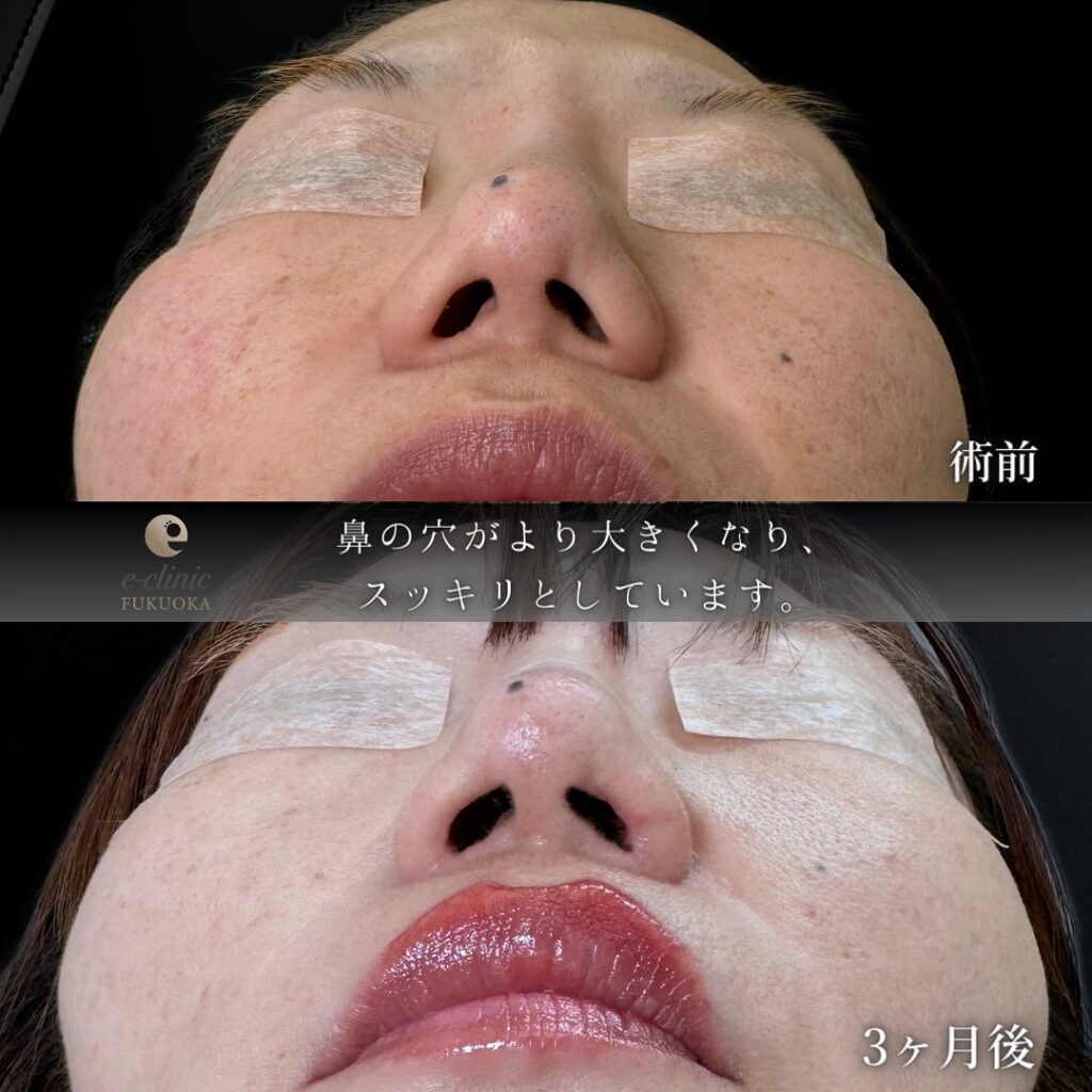 鼻孔縁挙上の症例写真 (1)