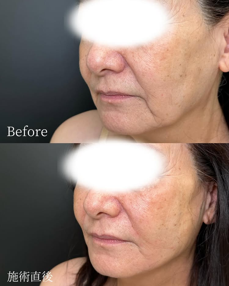 糸リフトの症例写真 (51)