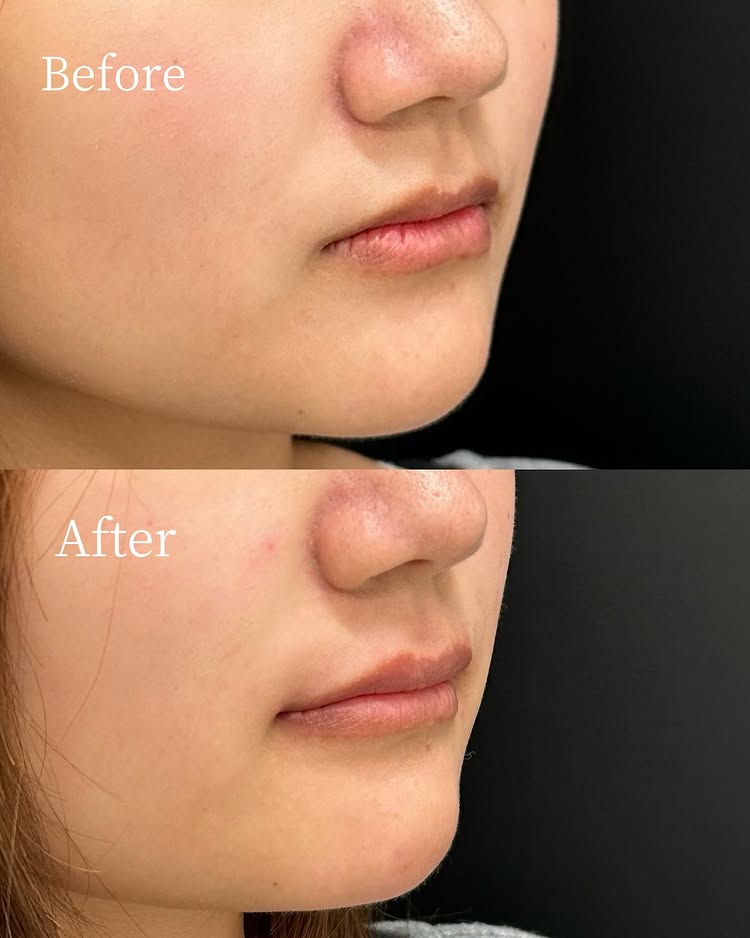 唇のヒアルロン酸の症例写真 (51)