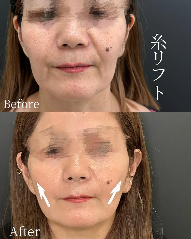 糸リフトの症例写真 (42)