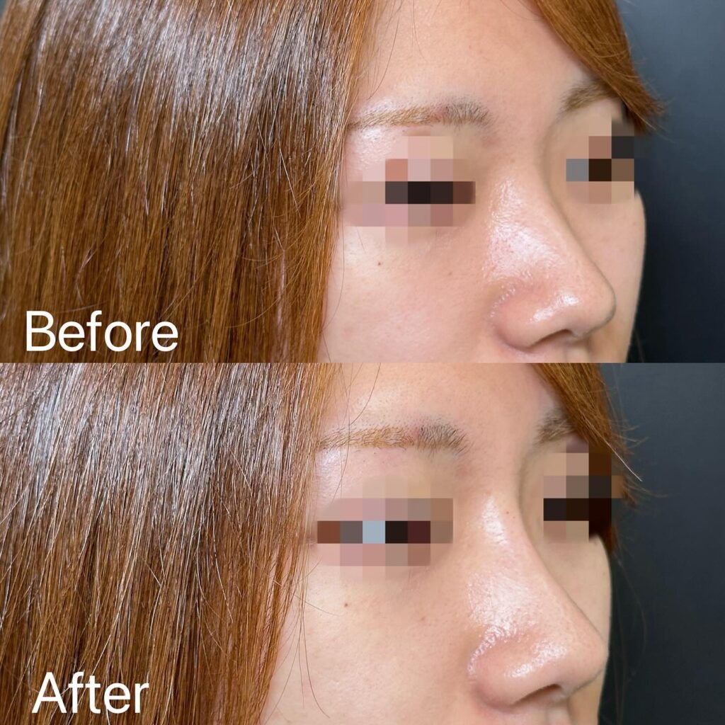 鼻のヒアルロン酸の症例写真 (2)